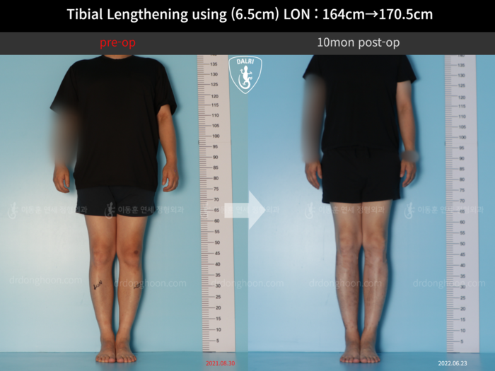 Tibial lengthening, 6.5 cm gained