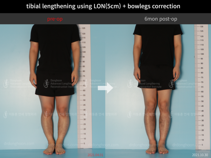 Tibial lengthening, 5 cm gained