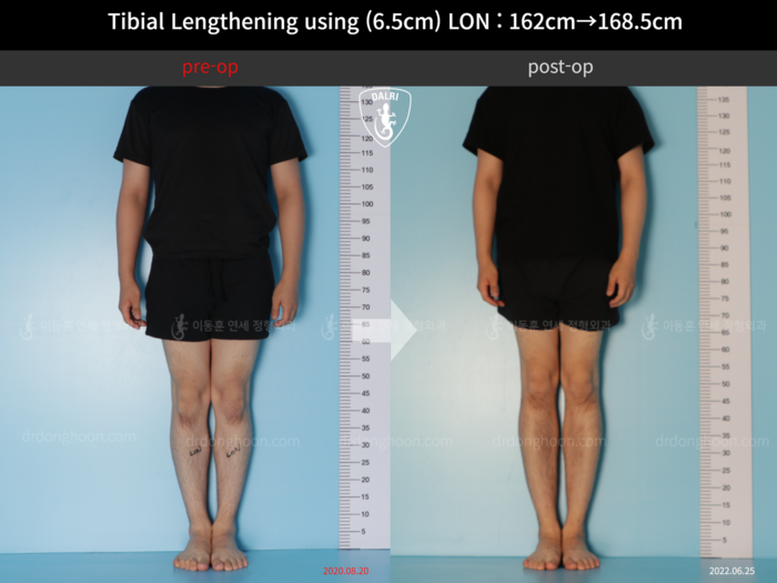 Tibial lengthening, 6.5 cm gained