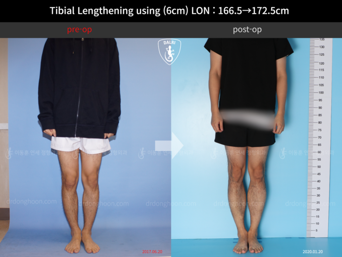 Tibial lengthening, 6 cm gained