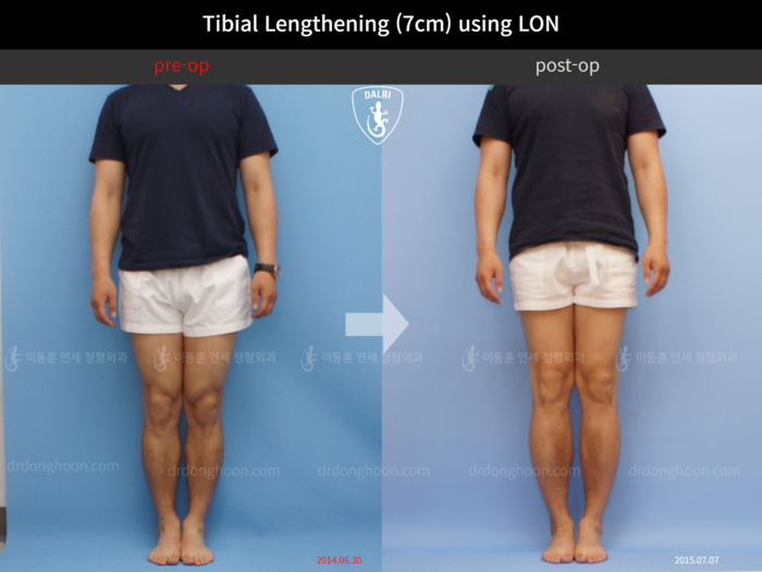 Tibial lengthening, 7 cm gained