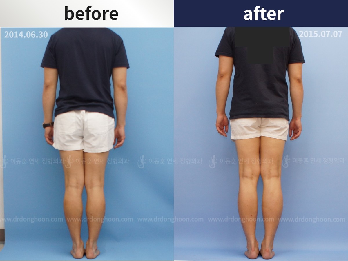 Tibial Lengthening (7cm) Using LON : DALRI Before & After