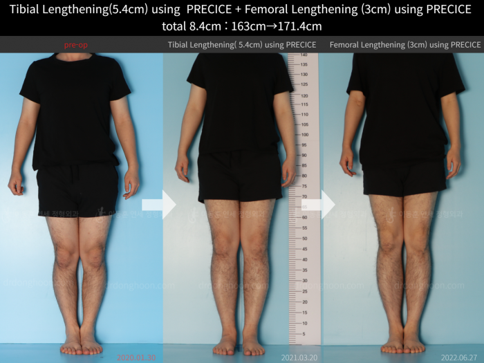 Femoral + tibial lengthening, 5.4 cm gained