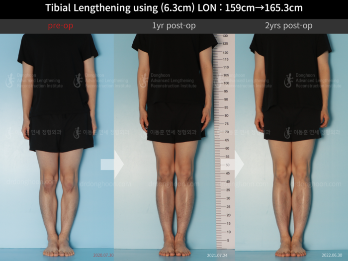 Tibial lengthening, 6.3 cm gained