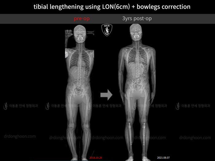 Tibial lengthening, 5.8 cm gained