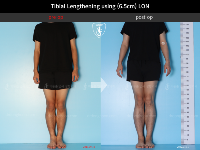 Tibial lengthening, 6.5 cm gained