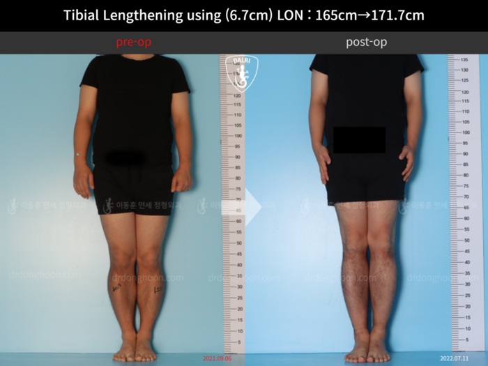 Tibial lengthening, 6.7 cm gained