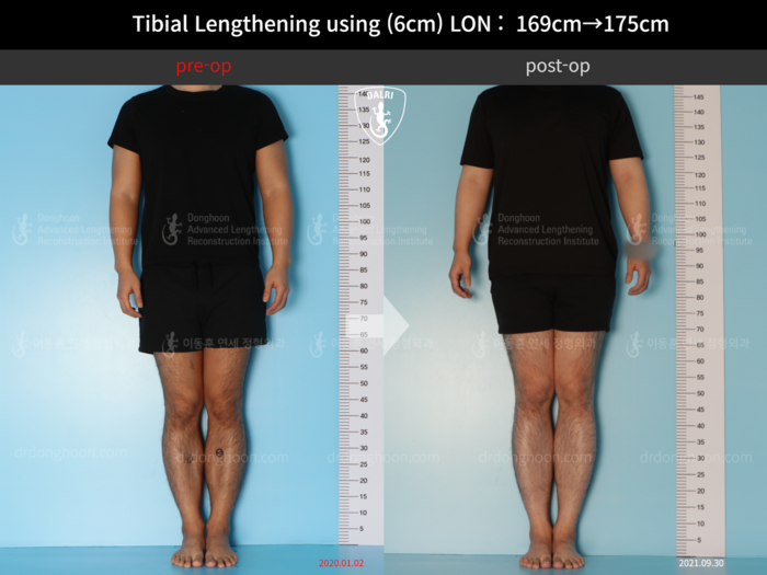 Tibial lengthening, 6 cm gained