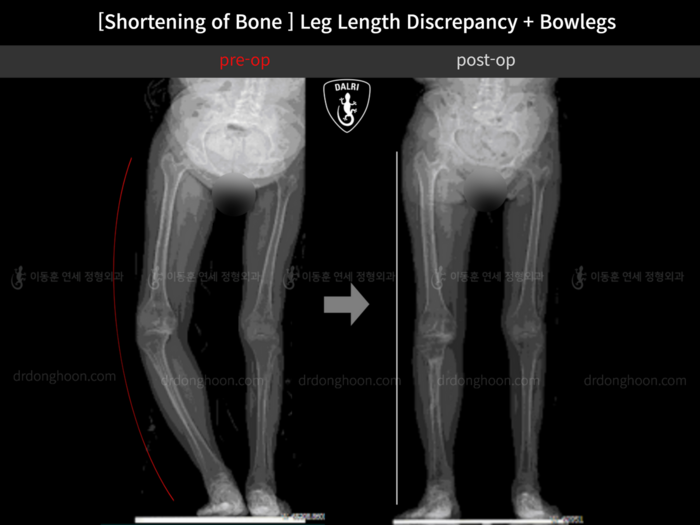 Leg length discrepancy before and after radiograph example 1