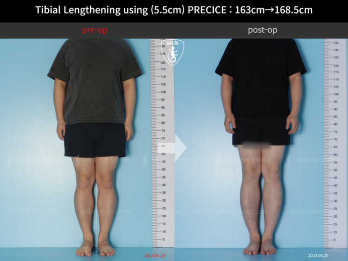 ยืดกระดูกหน้าแข้ง เพิ่มขึ้น 5.5 ซม.
