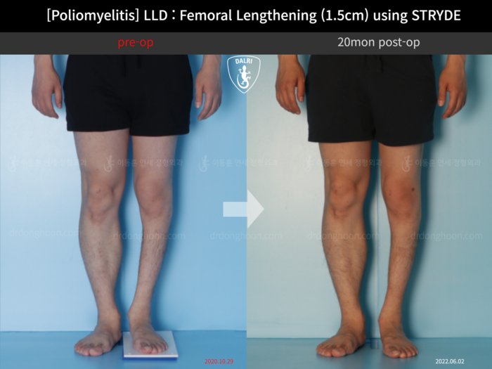 Femoral lengthening, 1.5 cm gained
