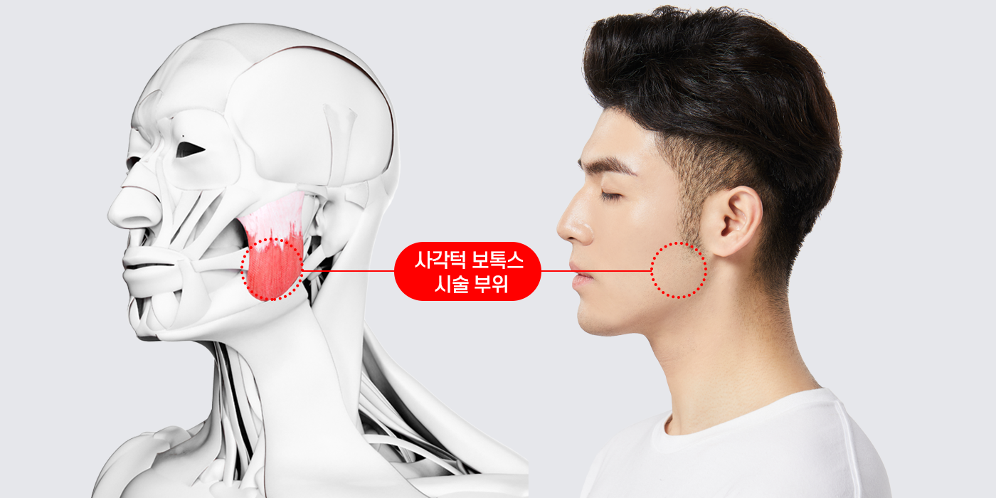 사각턱보톡스 시술부위