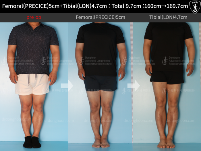 Femoral + tibial lengthening
