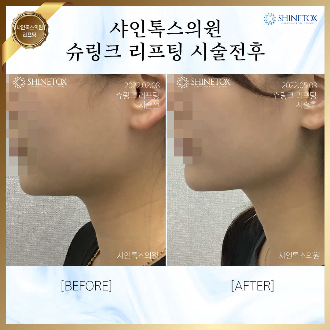 슈링크전후사진2