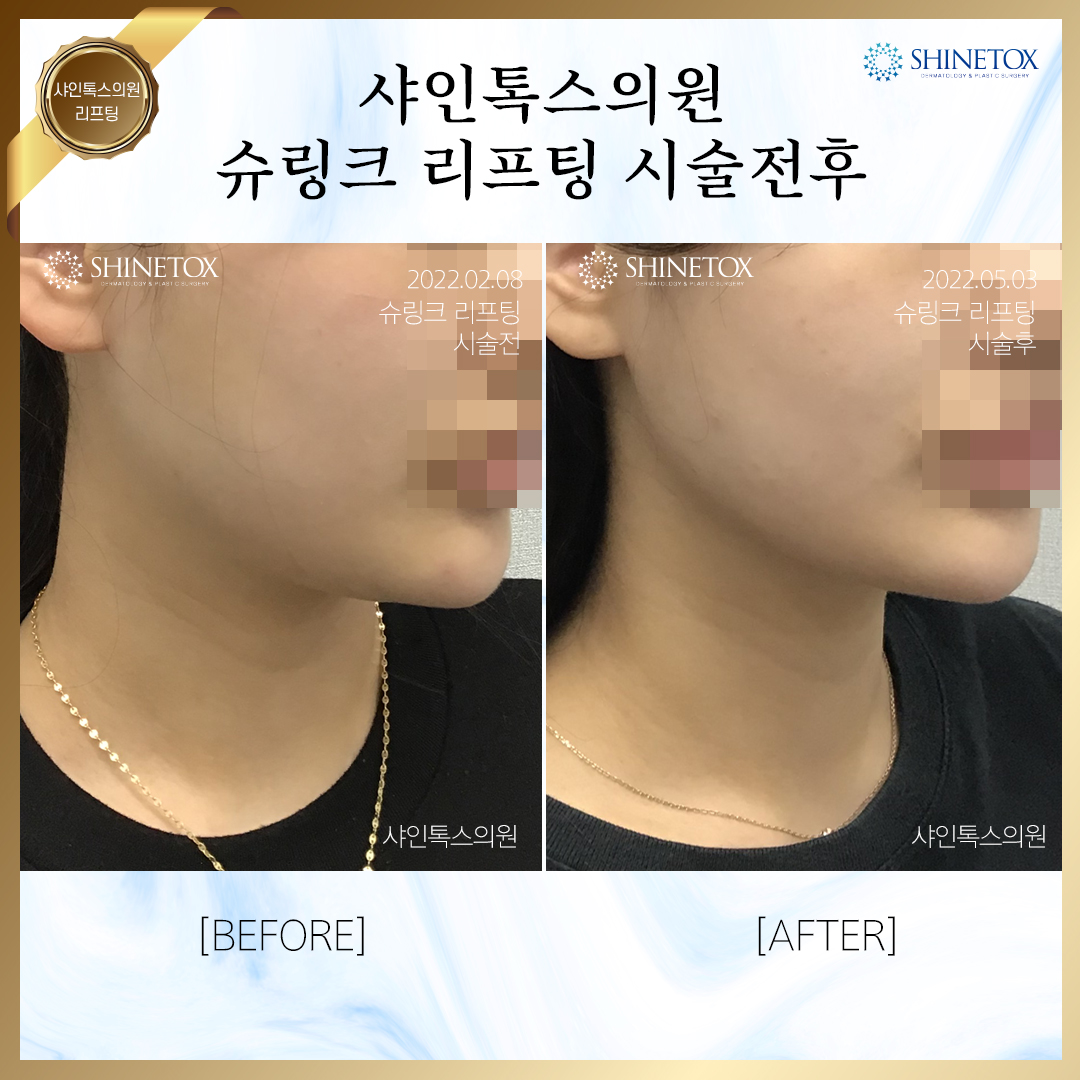 슈링크전후사진1