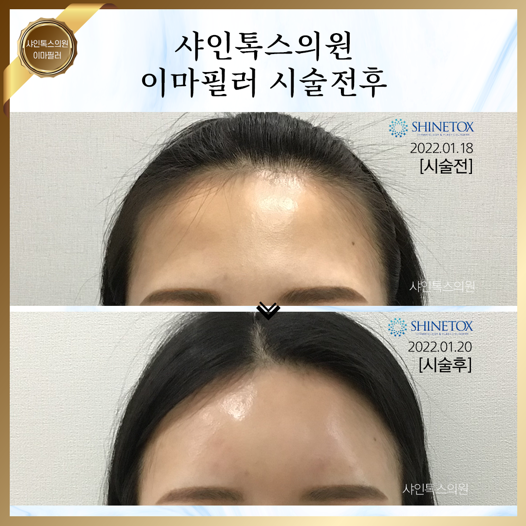 이마필러시술전후1