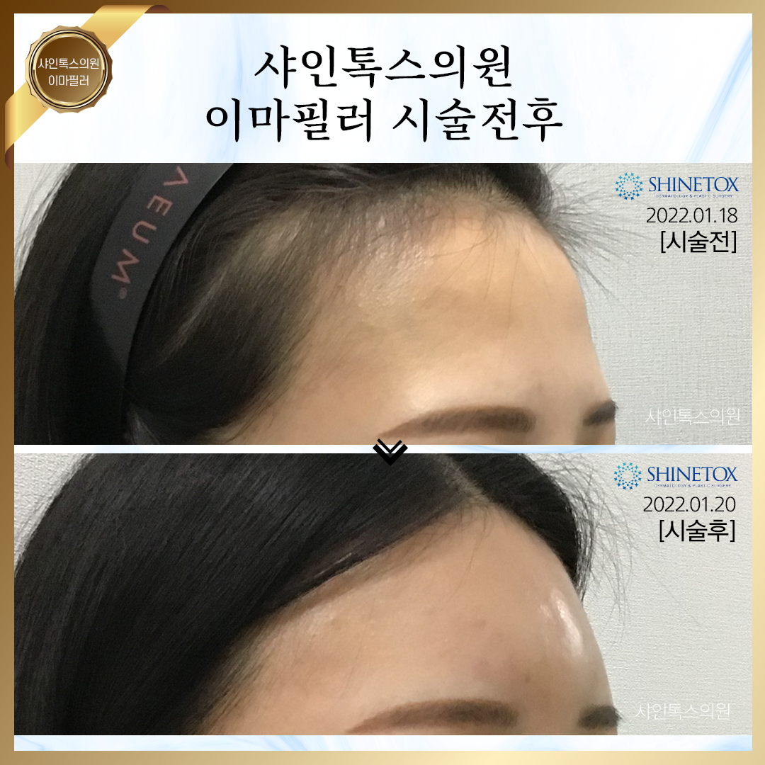 대전보톡스시술전후2