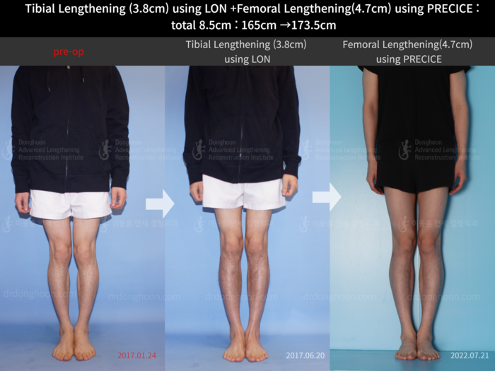 Femoral + tibial lengthening, 3.8 cm gained
