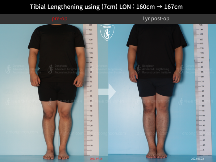 Tibial lengthening, 7 cm gained