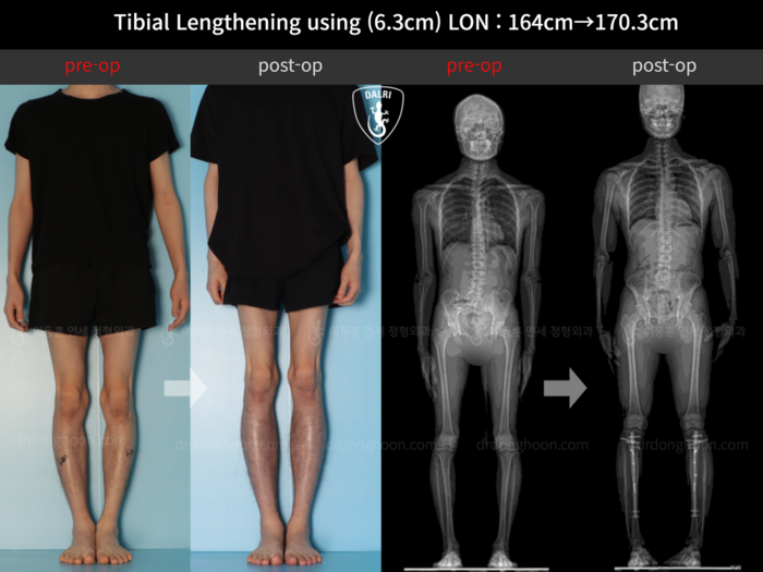 Tibial lengthening, 6.3 cm gained