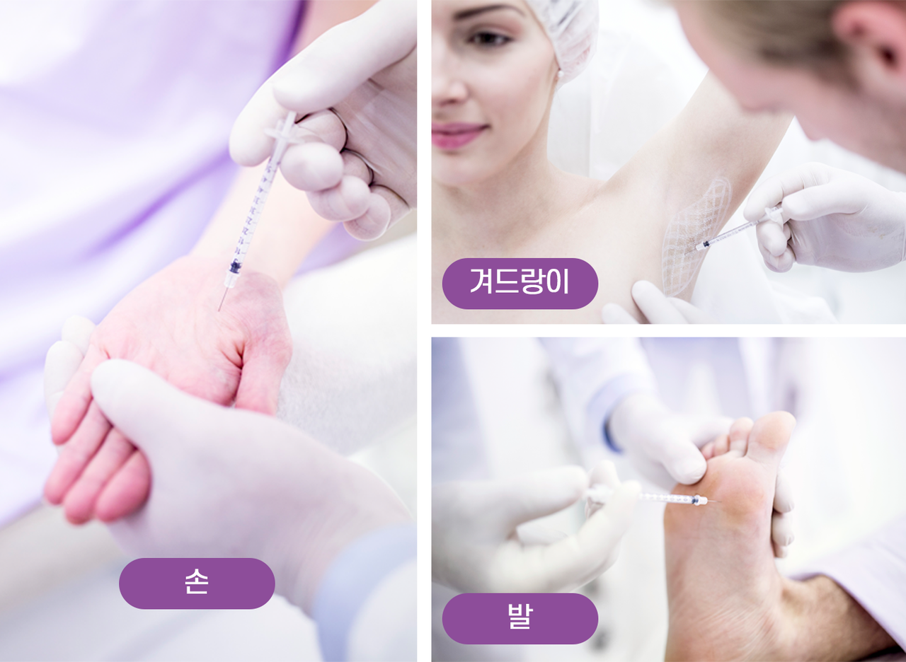 다한증보톡스 시술부위