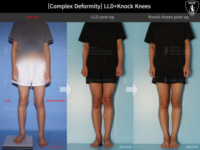 Paediatric & adolescent knock knees