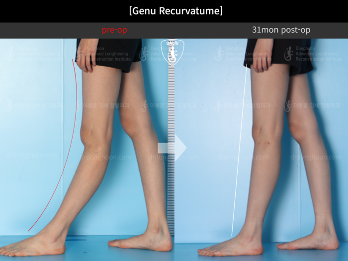 Genu recurvatum