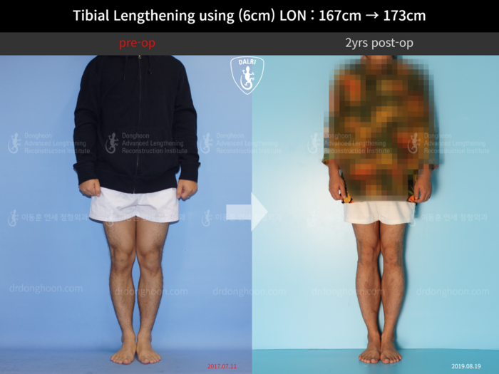Tibial lengthening, 6 cm gained