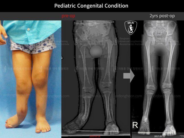 Paediatric congenital condition