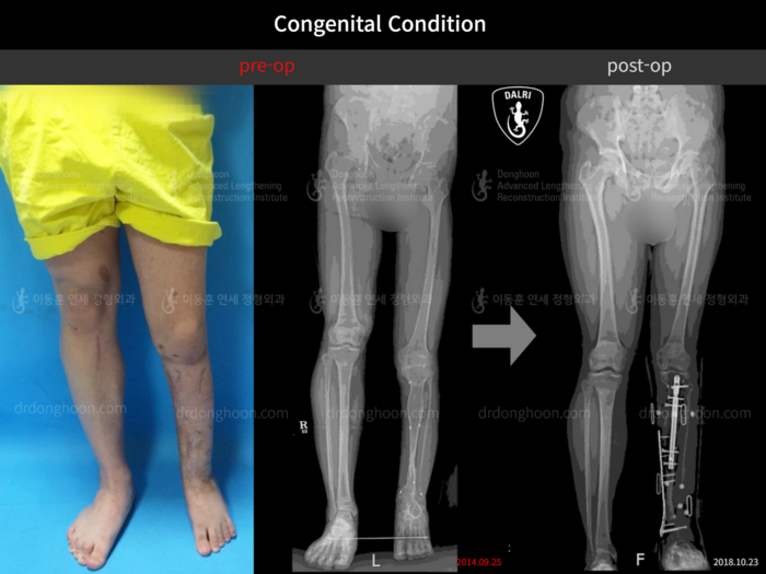 Congenital condition