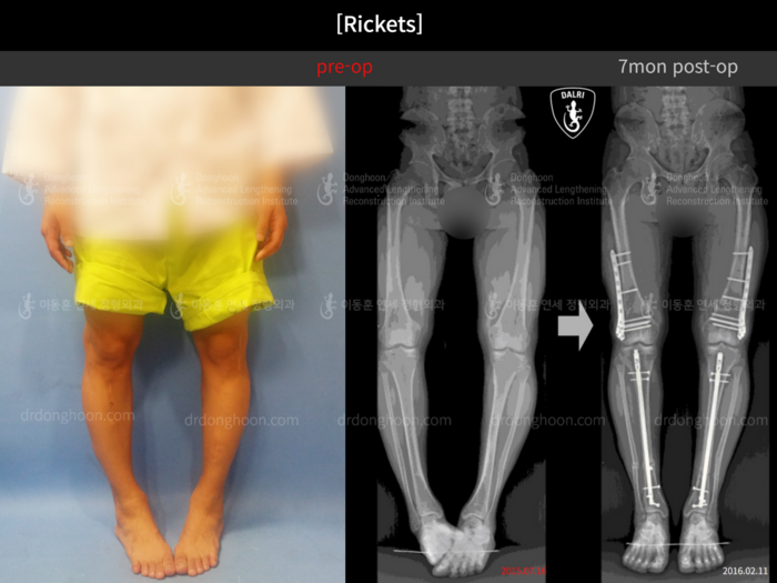 Congenital condition
