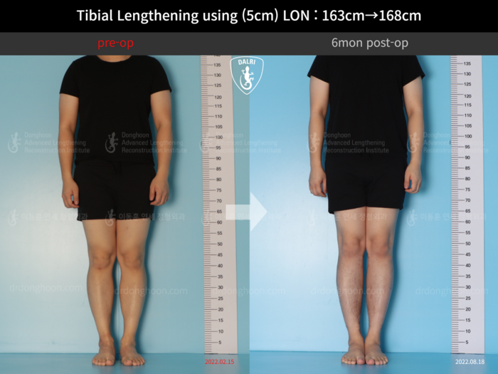 Tibial lengthening, 5 cm gained