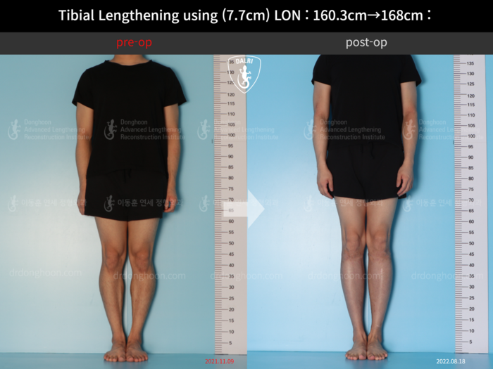 Tibial lengthening, 7.7 cm gained