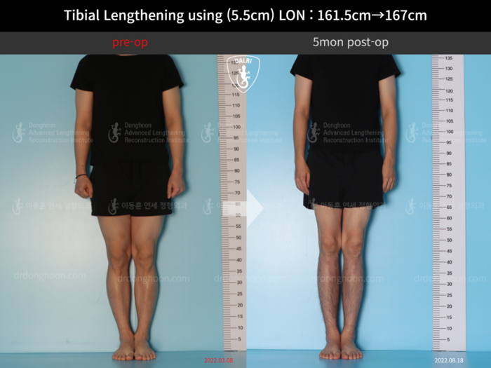 Tibial lengthening, 5.5 cm gained