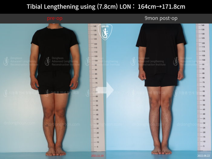 Tibial lengthening, 7.8 cm gained