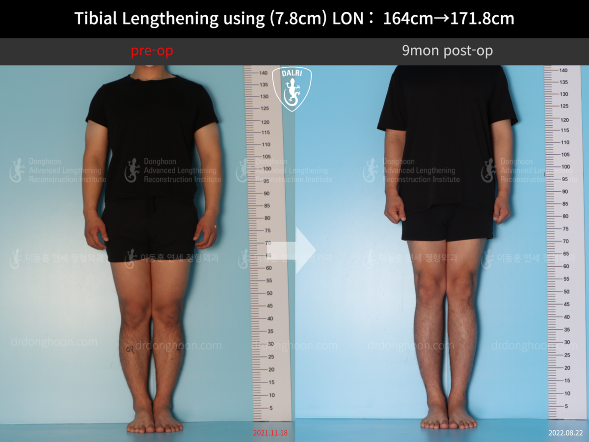 Tibial Lengthening Using (7.8cm) LON : 164cm→171.8cm : DALRI Before & After