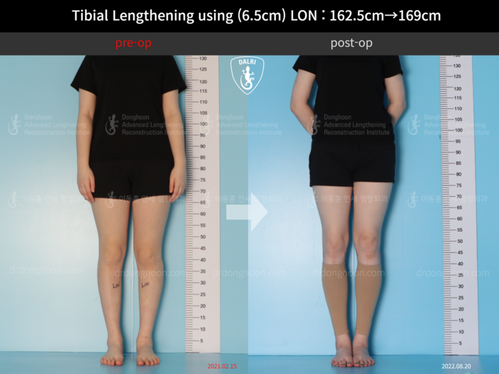 Tibial lengthening, 6.5 cm gained