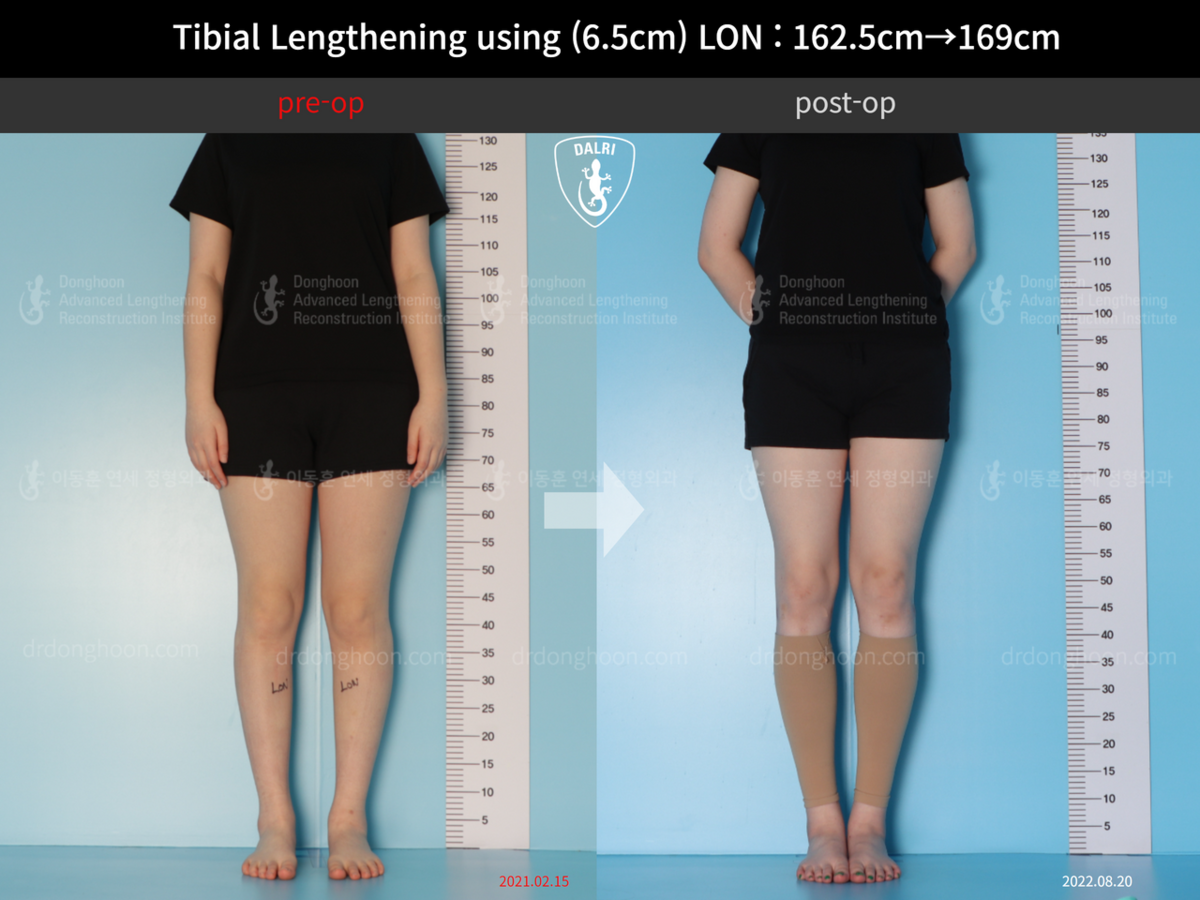 Tibial Lengthening Using (6.5cm) LON : 162.5cm→169cm : DALRI Before & After