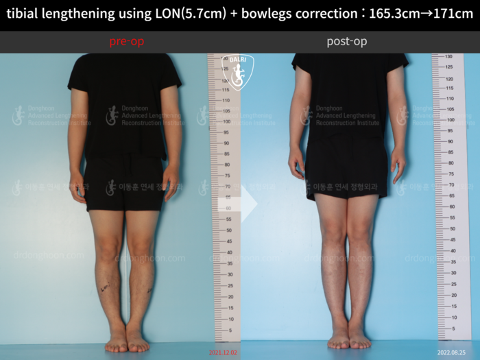 Tibial lengthening, 5.7 cm gained