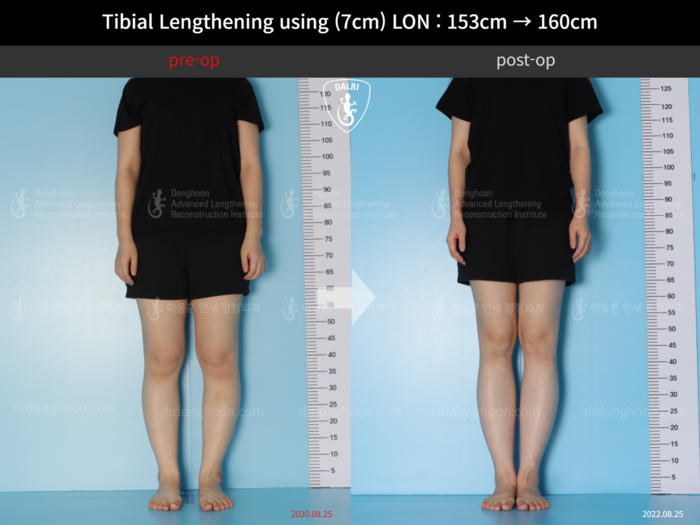 Tibial lengthening, 7 cm gained