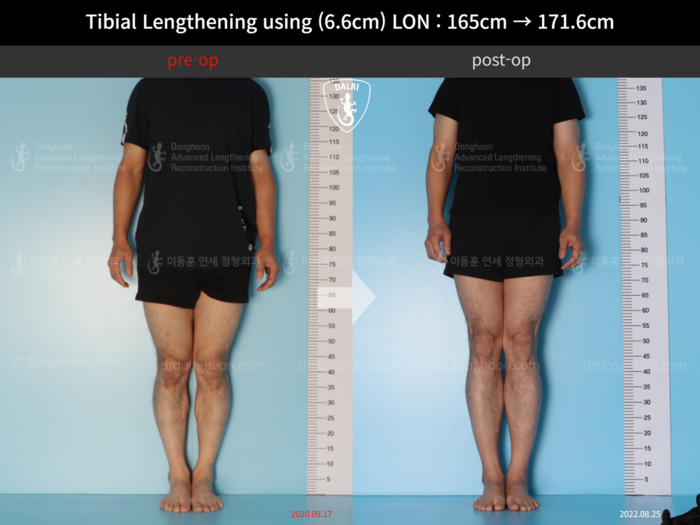 Tibial lengthening, 6.6 cm gained