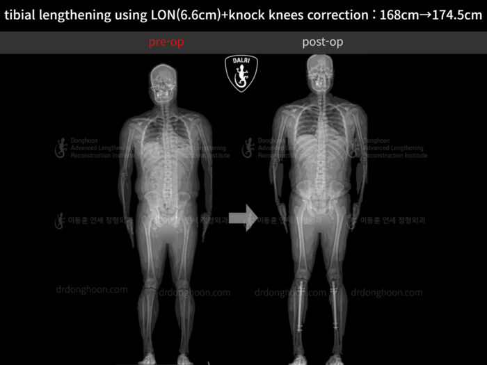 ยืดกระดูกหน้าแข้ง เพิ่มขึ้น 6.6 ซม.