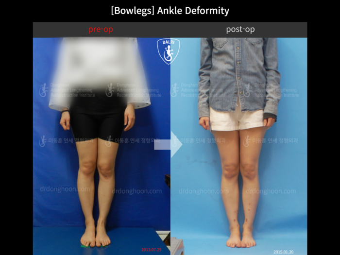 Foot & ankle deformity