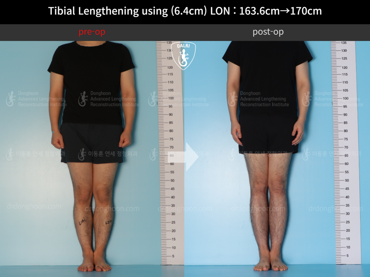 Tibial Lengthening Using (6.4cm) LON : 163.6cm→170cm : 9mon Post-op ...