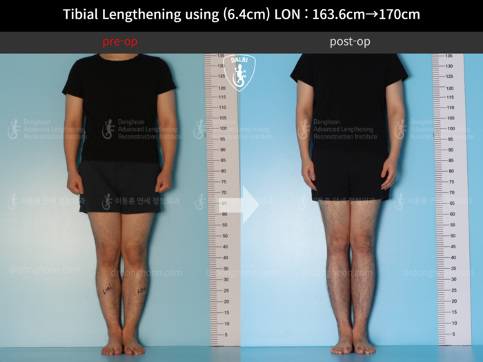 Tibial lengthening, 6.4 cm gained