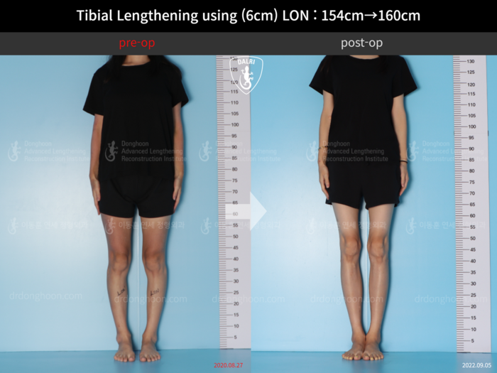 Tibial lengthening, 6 cm gained