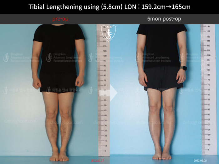 Tibial lengthening, 5.8 cm gained