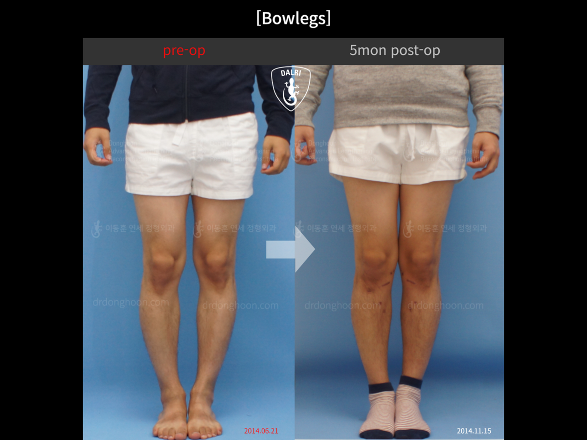 [Bowlegs] 5mon postop Adult Bowlegs