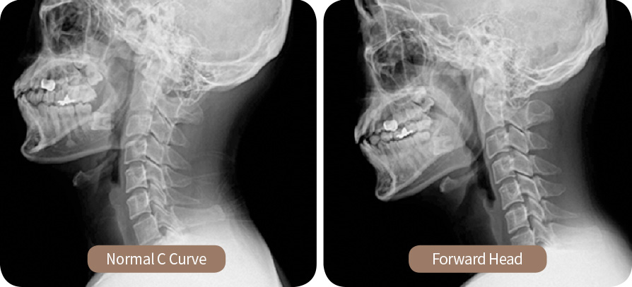 What is Forward Head / Turtle Neck?