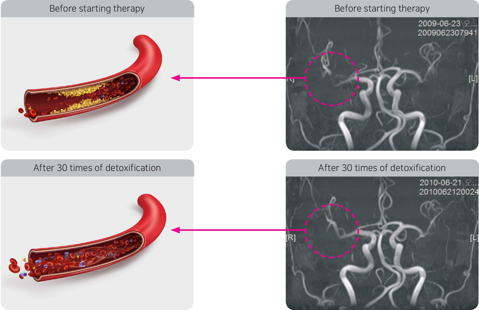 Results after chelation therapy for arteriosclerosis